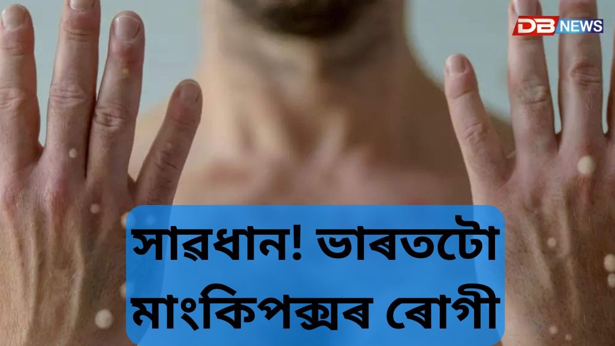 মাংকিপক্স