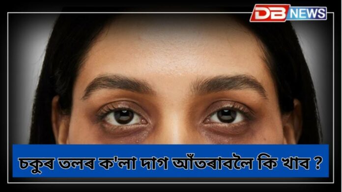 Dark Circles: কি ভিটামিনৰ অভাৱত ডাৰ্ক চাৰ্কল হয়, চকুৰ তলৰ ক'লা দাগ আঁতৰাবলৈ কি খাব ?