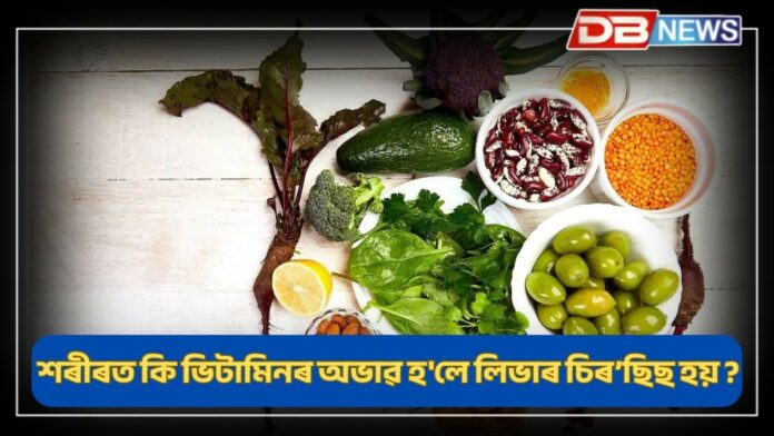 Liver Cirrhosis: শৰীৰত কি ভিটামিনৰ অভাৱ হ'লে লিভাৰ চিৰ’ছিছ হয় ?