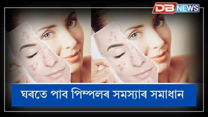 Skin Care: গৰমৰ বাবে পিম্পলৰ সমস্যা হৈছে নেকি? সমাধান আছে ঘৰতে !