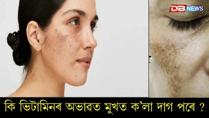 Vitamin: কি ভিটামিনৰ অভাৱত মুখ ক’লা হ’বলৈ আৰম্ভ কৰে ?