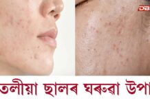 Oily Skin: গৰমৰ দিনত তেলীয়া ছালৰ পৰা মুক্তি পাব বিচাৰে নেকি ? এই ঘৰুৱা উপায়বোৰে আপোনাক সহায় কৰিব… Oily Skin: গৰমৰ দিনত তেলীয়া ছালৰ পৰা মুক্তি পাব বিচাৰে নেকি ?