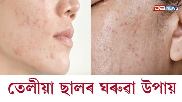 Oily Skin: গৰমৰ দিনত তেলীয়া ছালৰ পৰা মুক্তি পাব বিচাৰে নেকি ?